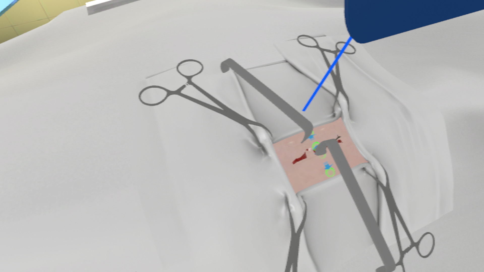 PST VR (Primary Surgical Treatment) #2